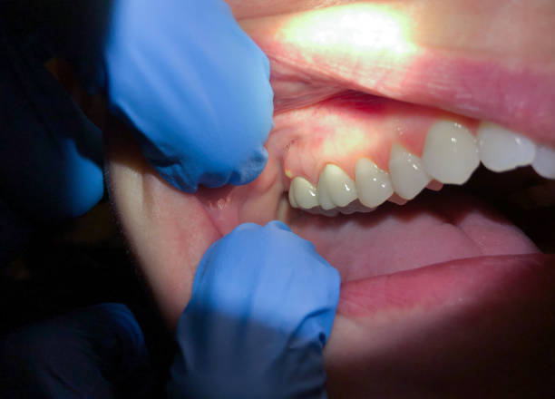 Best Emergency Dental Care for Broken or Chipped Teeth in Bellmawr, NJ